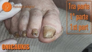 Onicauxis onychomycosis amp callosities Part 1 podologiaintegral [upl. by Anon]