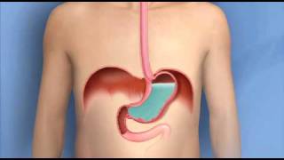 Gastroesophageal Reflux Disease GERD – Causes Symptoms and Treatment – DrBerg [upl. by Annayak]