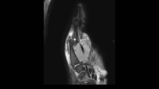 Extensor pollicis longus tendon tear [upl. by Eadrahs]