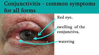 Red or pink eye  Conjunctivitis symptoms and treatment [upl. by Fredenburg]