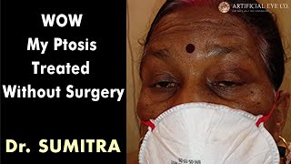 Wow Ptosis Treatment Without Surgery  Dr Sumitra [upl. by Ahsok]