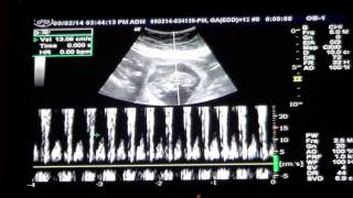 Baby 12 Week Ultrasound amp Heartbeat [upl. by Oivalf130]