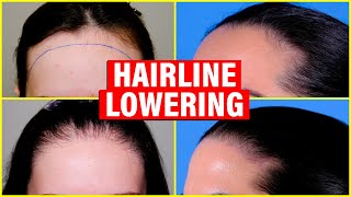 Hairline Lowering Hair Transplant vs Surgical Hairline Advancement [upl. by Monteith]