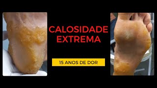 Impressionante Calosidade Extrema nos Pés  15 ANOS COM DOR PARTE 1 [upl. by Roderica]