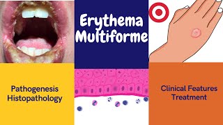 Erythema multiforme [upl. by Cirred]