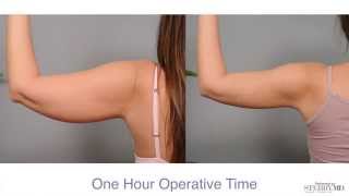 Get Firm Sculpted Arms With Smartlipo™  Dr Sterry Explains [upl. by Galen]