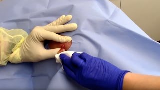 Abscess Drainage Performed by Dermatologist Dr David Myers [upl. by Ynaffik]