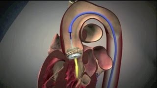 Transcatheter Aortic Valve Implantation TAVI [upl. by Sugirdor]