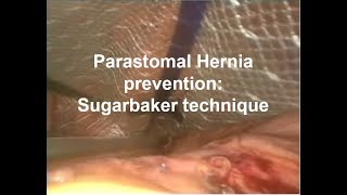 Parastomal Hernia Prevention Sugarbaker technique [upl. by Jenn]