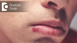 12 Ways To Get Rid Of Fordyce Spots On Lips  Healthspectra [upl. by Nilson]