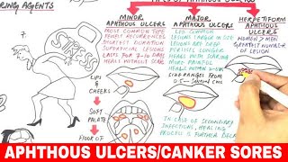 Aphthous Ulcers  Canker Sores  Pathophysiology Triggers Types amp Treatment [upl. by Naux]