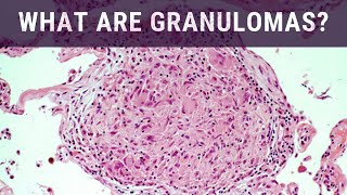 Medications for Chronic Granulomatous Disease [upl. by Meuse]