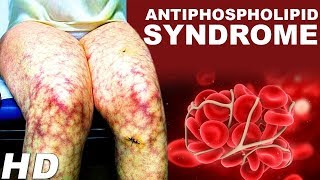 Antiphospholipid Antibody Syndrome An Autoimmune Disease  Antiphospholipid Treatments And Symptoms [upl. by Edina]