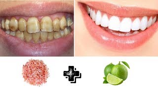 COMO BLANQUEAR LOS DIENTES EN 2 MINUTOS REMEDIO CASERO [upl. by Eirojam]