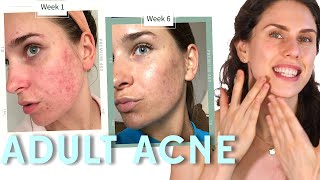 Treating Adult Acne  How To amp What To Look For [upl. by Jari667]