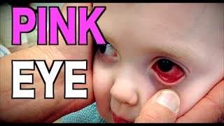 PINK EYE Live Diagnosis Conjunctivitis  Dr Paul [upl. by Filip]