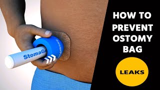 How to prevent Ostomy Bag Leaks [upl. by Altaf641]