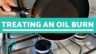 Treating an OIL BURN  What To Do [upl. by Helli]