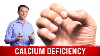 Causes amp Symptoms Of Calcium Deficiency – Dr Berg [upl. by Gipps76]