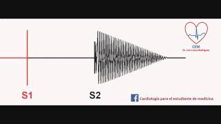 Soplo de la insuficiencia aórticaAortic Insufficiency murmur [upl. by Sirrom642]