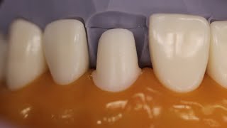 PFM Anterior Tooth Preparation [upl. by Meredith]