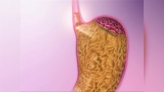 Acid Reflux Natural Remedies [upl. by Sessilu]