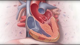 A patients experience with hypertrophic cardiomyopathy [upl. by Cirdnek]