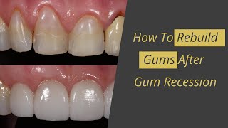 Gum Recession Cure  How to Rebuild Gums [upl. by Anyalram876]