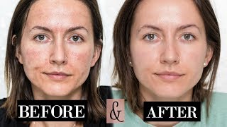 My MICRONEEDLING Experience  Skin Updates  Before amp After [upl. by Floss205]