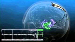 Absence Seizure hyperventilation test [upl. by Tevlev]