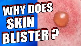 Why Does Skin Blister  How To Treat amp Prevent Skin Blisters Naturally [upl. by Darnok859]