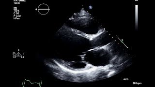 Ischemic Cardiomyopathy 2D Echocardiogram [upl. by Peednus]