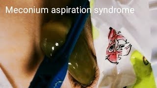 Meconium Aspiration Syndrome  Pediatrics [upl. by Claudia]