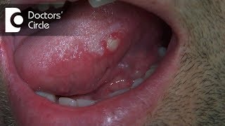 blisters from mosquito bites  before and after treatment [upl. by Enialedam]