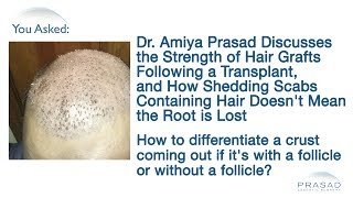 Why Dislodged Scabs Containing Hair After a Hair Transplant Doesnt Mean That Hair Grafts are Lost [upl. by Cooley455]