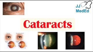 The Use of Glasses After Cataract Surgery with Dr Graham Fraenkel [upl. by Adil]