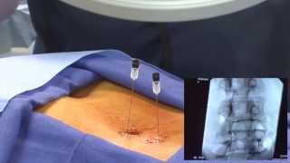 WATCH an Epidural Steroid Injection Demonstration  LIVE [upl. by Anitnahs]