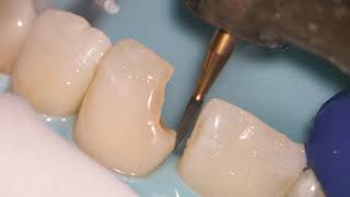 Teeth Bonding  Front tooth filling EXPLAINED [upl. by Petr]