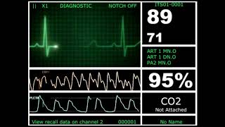 Hospital Monitor Flatline to Alive HD [upl. by Redlac]