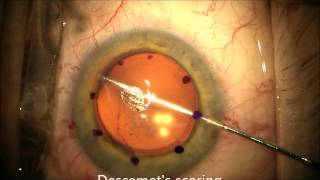 Descemet’s Membrane Endothelial Keratoplasty DMEK [upl. by Yadsnil]