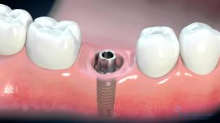 Dental Implant Consent Video [upl. by Assedo39]