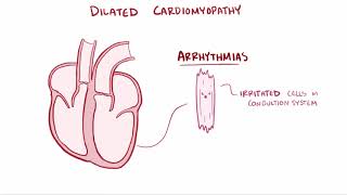 Cardiomyopathy Overview Restrictive Dilated Hypertrophic pathophysiology symptoms [upl. by Enelrae416]