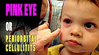 LIVE DIAGNOSIS Pink Eye or Periorbital Cellulitis  Dr Paul [upl. by Niliram]