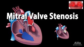 Mitral Valve Stenosis Animation [upl. by Eleaffar]