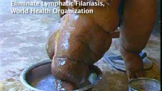 Elephantiasis Afflicts 120 Million in Africa Asia [upl. by Aracat]