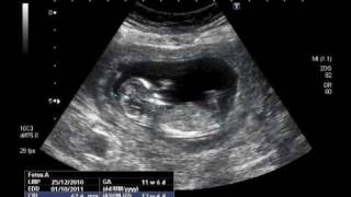 12 week Pregnancy Ultrasound [upl. by Alset]