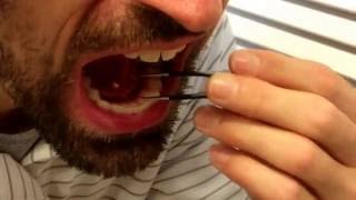 Removing my own salivary gland stone [upl. by Hartzel975]