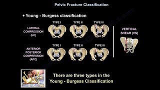 Pelvic Fractures  Everything You Need To Know  Dr Nabil Ebraheim [upl. by Amora]