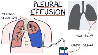 Understanding Pleural Effusions [upl. by Averill]