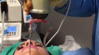 Chin Liposuction [upl. by Royce596]